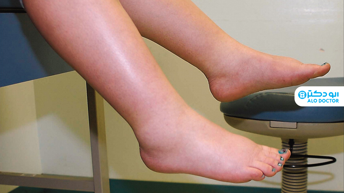 برای کدام ورم پا باید به پزشک مراجعه کرد؟
