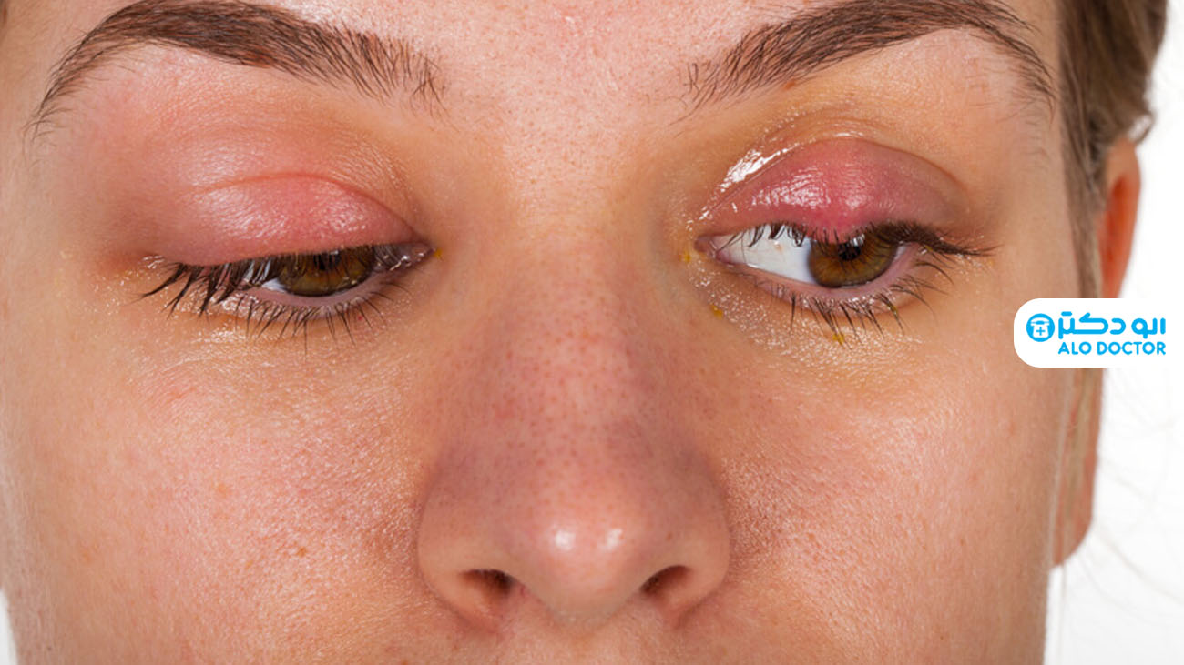درمان سه سوته عفونت چشم