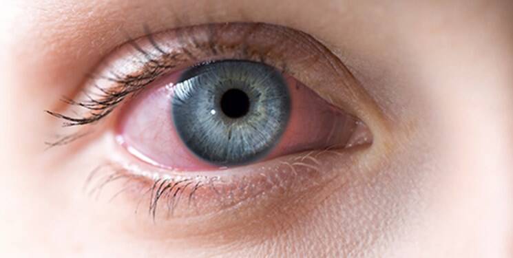 چشم صورتی چیست؟ + انواع آنتی‌ بیوتیک ها برای درمان آن