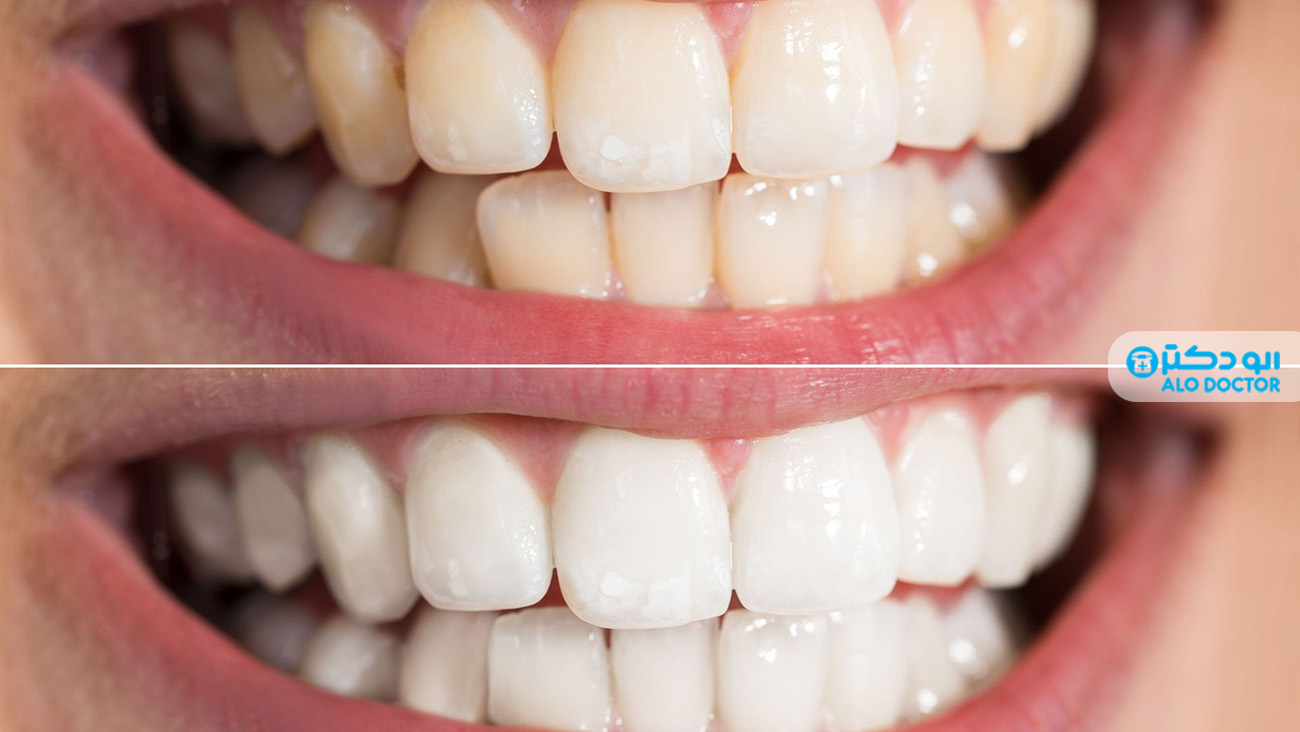 روش های طبیعی سفید کردن دندان ها