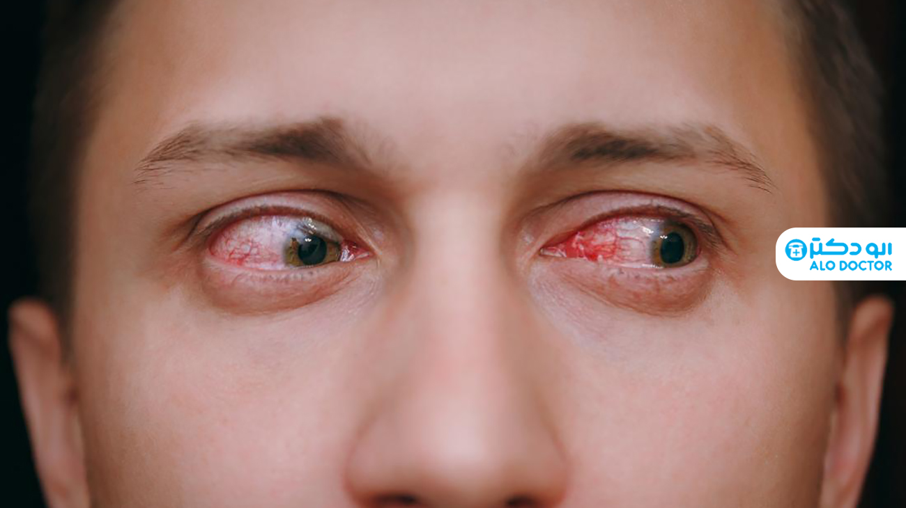 علت قرمزی چشم و راه های درمان آن