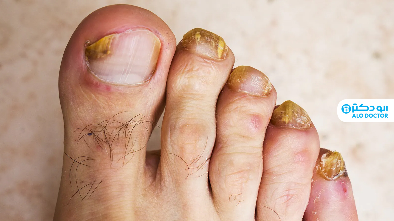 درمان های خانگی برای قارچ ناخن پا