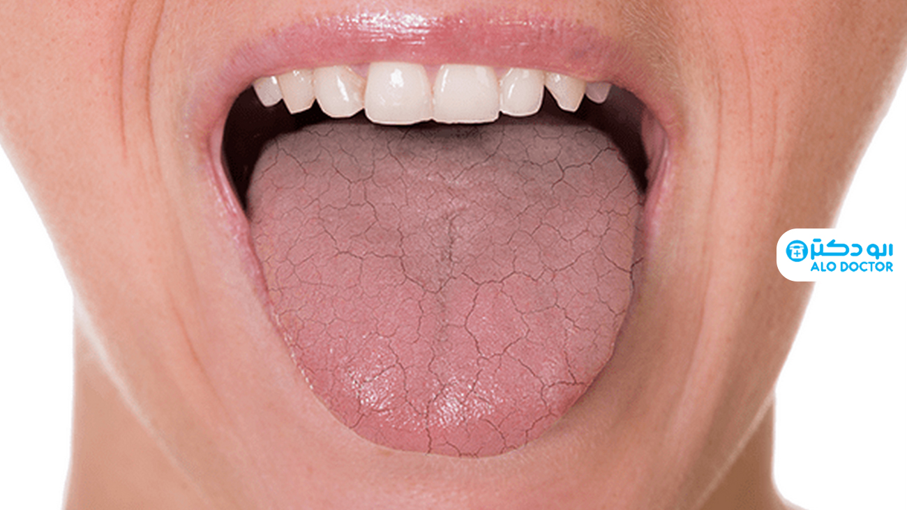 علت خشکی دهان / علائم آن چیست؟