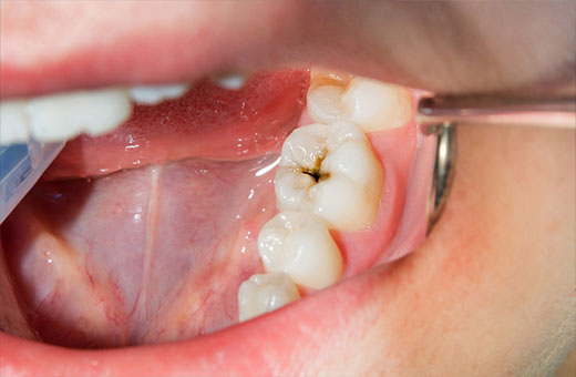 معرفی پرکاربردترین ابزارهای ترمیم پوسیدگی دندان