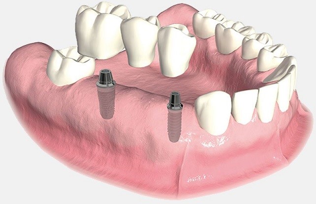 ایمپلنت دندانی چیست؟