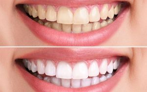 عوارض بلیچینگ دندان چه مواردی هستند؟
