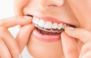 راحتتر شدن بهداشت دهان و دندان در ارتودنسی نامرئی