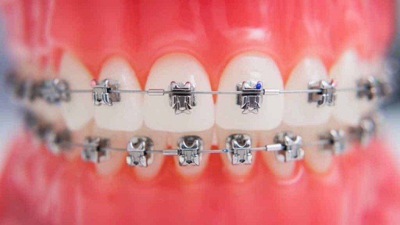 ارتودنسی دندان چیست؟ آشنایی با انواع ارتودنسی