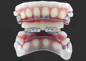 ارتودنسی متحرک دندان