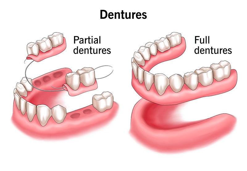 بهترین دندان مصنوعی کدام نوع است؟