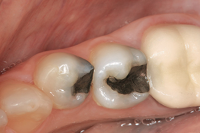نقش کیفیت امالکپ، فایل روتاری و اسید اچ در دندانپزشکی