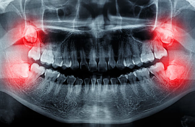 باورهای غلط در مورد دندان عقل + چه زمانی برای کشیدن آن اقدام کنیم؟