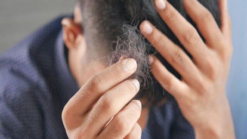 درمان جدید برای رویش مجدد موی این بیماران