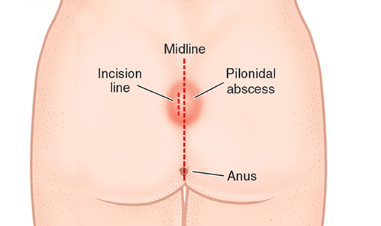 درمان آبسه مقعدی