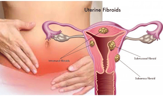 علل و علائم فیبروم رحم