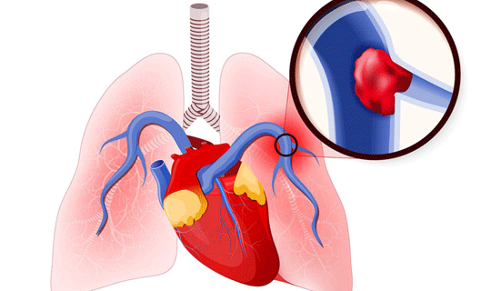 Syncope paradox in the outcome of patients with pulmonary thromboembolism