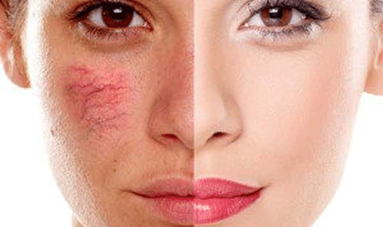 علت برجسته شدن رگ های دست و صورت و درمان آن