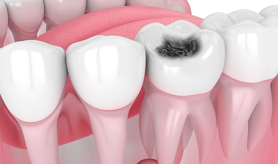 عوامل کمک کننده به پوسیدگی دندان را بشناسید