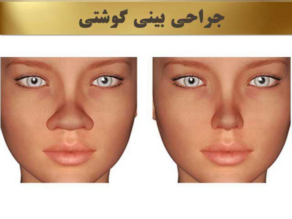 بینی گوشتی