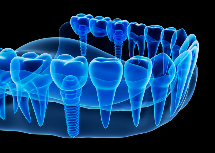 کاشت دندان دیجیتال چیست؟ /  مزایای کاشت دندان دیجیتال را بشناسید